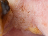 m. Bowen bij GATA2 deficiëntie