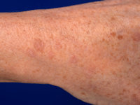 HPV-geïnduceerde papillomen bij GATA2 deficiëntie