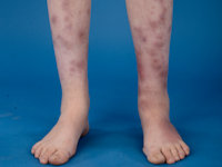 Erythema nodosum bij GATA2 deficiëntie