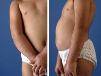 Gianotti-Crosti syndroom