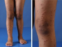 Gianotti-Crosti syndroom