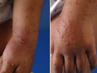 Gianotti-Crosti syndroom