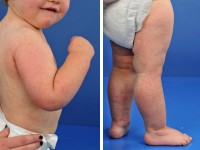 Gianotti-Crosti syndroom