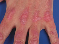 Gottron's sign bij dermatomyositis