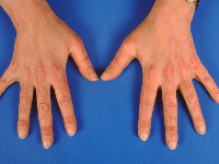 Gottron's sign bij dermatomyositis