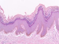 Histologisch beeld Gougerot-Carteaud syndroom 