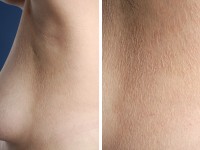 Gougerot-Carteaud syndroom 