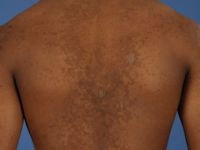 Gougerot-Carteaud syndroom 