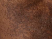 Gougerot-Carteaud syndroom 