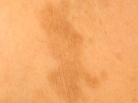 Gougerot-Carteaud syndroom 