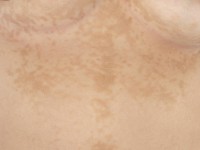 Gougerot-Carteaud syndroom 