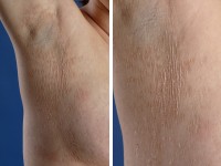 Gougerot-Carteaud syndroom 