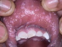 Heck's disease (focale epitheliale hyperplasie)