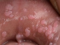 Heck's disease (focale epitheliale hyperplasie)