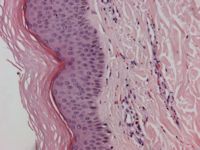 Henoch-Schönlein purpura