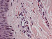 Henoch-Schönlein purpura