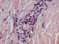 Henoch-Schönlein purpura