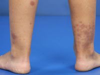 Henoch-Schönlein purpura