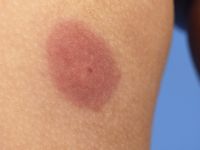 Henoch-Schönlein purpura