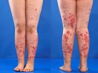 Henoch-Schönlein purpura