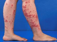 Henoch-Schönlein purpura