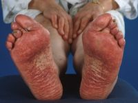 Henoch-Schönlein purpura