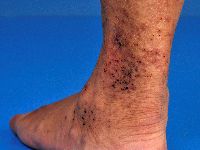 Henoch-Schönlein purpura