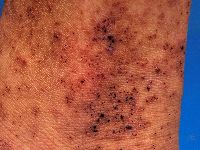 Henoch-Schönlein purpura