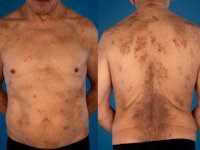 IgG4-related skin disease