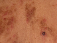 IgG4-related skin disease