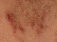 IgG4-related skin disease