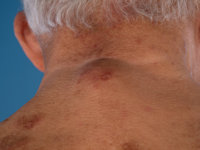 IgG4-related skin disease