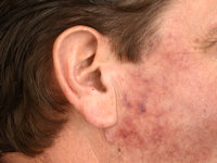 IgG4-related skin disease