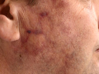 IgG4-related skin disease