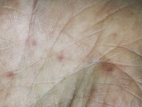 Janeway lesions
