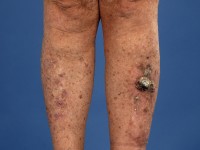 Multipele keratoacanthomen