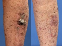 Multipele keratoacanthomen