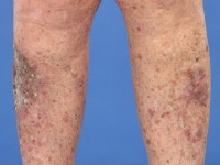 Multipele keratoacanthomen