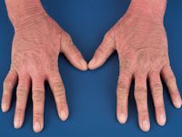 KLICK syndroom - gegeneraliseerde ichthyosis