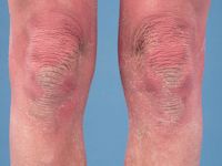 KLICK syndroom - hyperkeratotische plaques