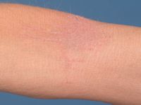 KLICK syndroom - lineair gerangschikte hyperkeratotische papeltjes in de plooien