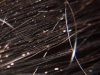 Piedra alba, white piedra, schimmelinfectie haren