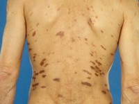 Kaposi sarcoma in dennenboom configuratie