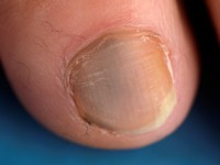 Subunguaal Kaposi sarcoom