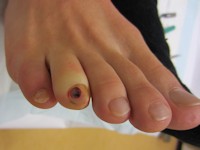 Subunguaal Kaposi sarcoom