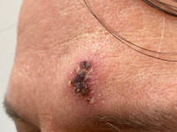 Kikuchi-Fujimoto disease