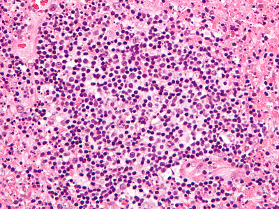 Kikuchi-Fujimoto disease