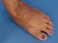 Reticulate acropigmentation van Kitamura