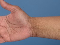 Reticulate acropigmentation van Kitamura