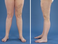 Klippel Trenaunay syndroom